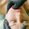 Facelift Buccal Facial