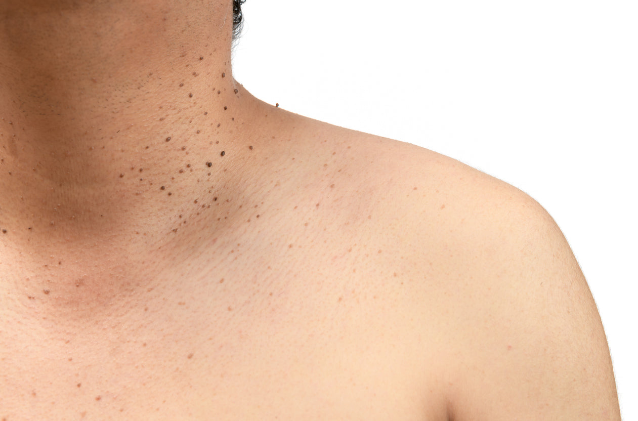 SKIN IMPERFECTIONS